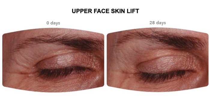 700x300 upper face skin lift