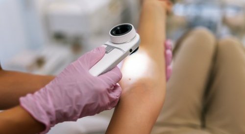 UV rays are responsible for over 80% of global melanoma cases, says WHO agency